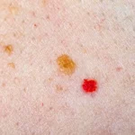 1747897619-cherry-angioma-e456f98ada45460db3aeba89281cf3e3-690x480