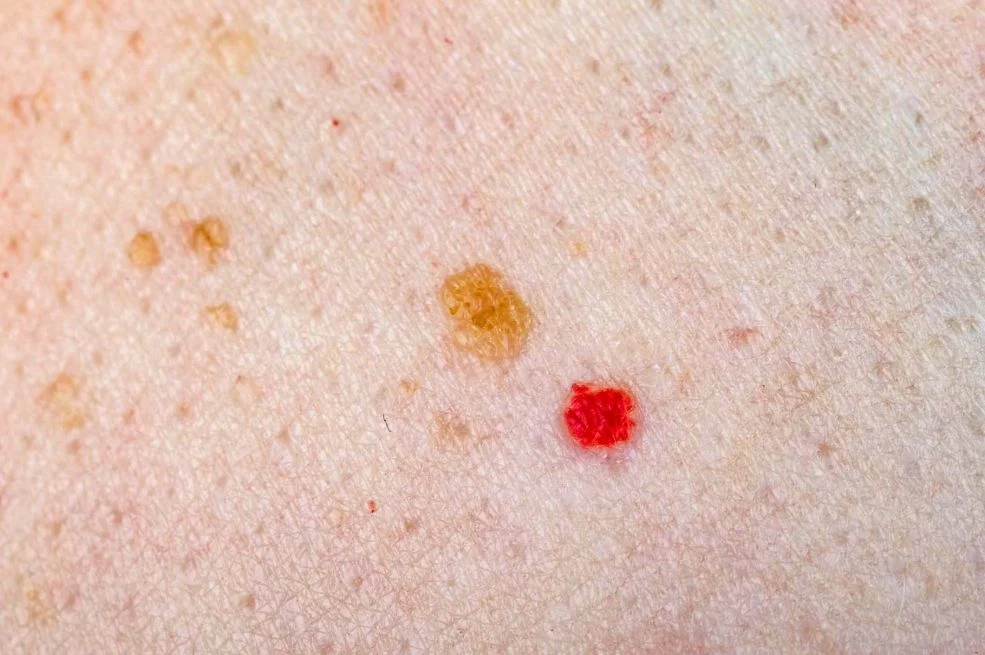 1747897619-cherry-angioma-e456f98ada45460db3aeba89281cf3e3-690x480
